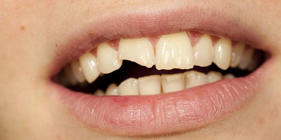 causes-of-broken-tooth-casula