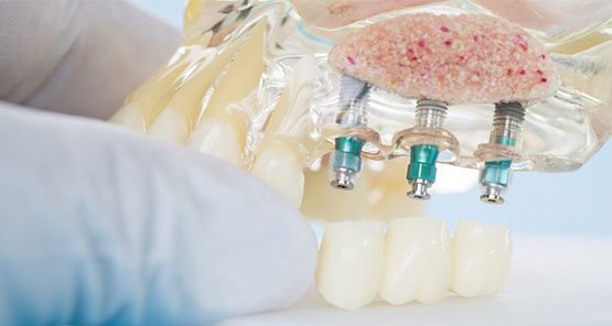 dental-implants-blurb-casula
