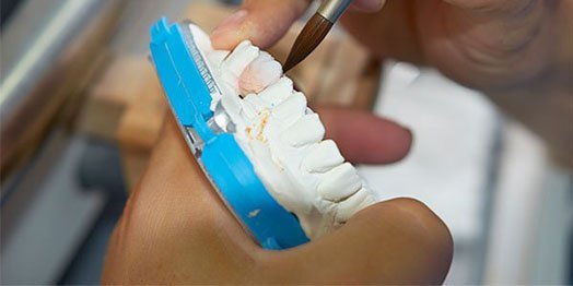 dental-restorations-casula