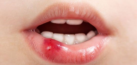 soft-tissues-injuries-in-the-mouth-casula