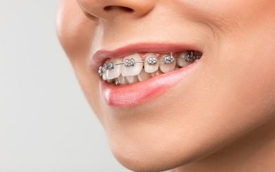 The Importance of Correcting your Overbite from Casula Dental Care