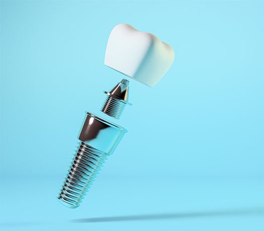 the dental implant procedure casula