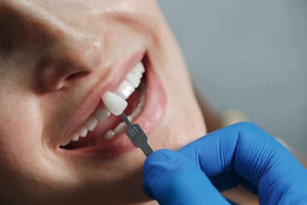 5 benefits of dental veneers for improving your smile casula dental care