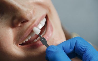 5 Benefits of Dental Veneers for Improving Your Smile