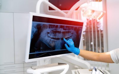 Bone Grafting: What Patients Should Know Before the Procedure