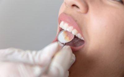 Lost Fillings? Don’t Leave Your Tooth Exposed!